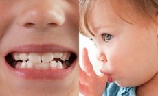 Điều trị sớm khớp cắn ngược răng sữa ở trẻ