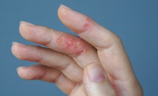 6 lưu ý quan trọng cho người bị viêm da cơ địa khi thời tiết khô hanh