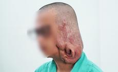 Bóc tách khối u sợi thần kinh khổng lồ gần 1 kg, trả lại diện mạo cho chàng trai trẻ