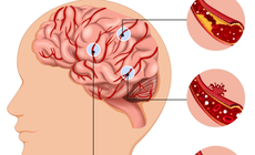 Bệnh nhân 87 tuổi hôn mê sâu do xuất huyết não, cảnh báo nguy cơ và cách phòng ngừa căn bệnh nguy hiểm