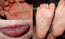 Bệnh tay ch&#226;n miệng d&#249;ng thuốc như thế n&#224;o?