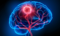 Tưởng ngất do đột quỵ, người phụ nữ 36 tuổi bất ngờ phát hiện ung thư máu