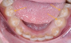 Răng c&#243; n&#250;m phụ – nguy cơ biến chứng nếu kh&#244;ng điều trị kịp thời