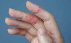 Bệnh vi&#234;m da cơ địa tăng nặng khi thời tiết lạnh, kh&#244;