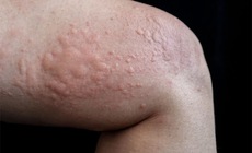 Nguy&#234;n nh&#226;n nổi mề đay thường gặp g&#226;y ngứa ng&#225;y, kh&#243; chịu