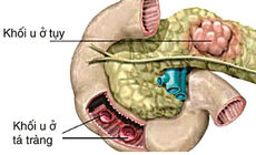 C&#226;u hỏi thường gặp li&#234;n quan đến hội chứng Zollinger-Ellison