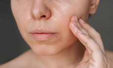Da dầu c&#243; cần d&#249;ng kem dưỡng ẩm v&#224;o m&#249;a h&#232; kh&#244;ng?