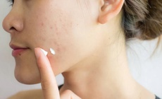 Da mụn n&#234;n trang điểm thế n&#224;o vừa che khuyết điểm vừa kh&#244;ng g&#226;y b&#237; da?