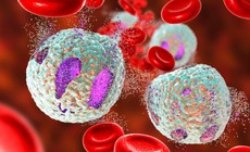 Leukemia kinh d&#242;ng bạch cầu hạt: Nguy&#234;n nh&#226;n, biểu hiện, c&#225;ch điều trị v&#224; ph&#242;ng bệnh