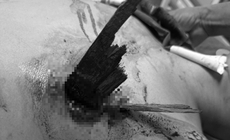 Cứu sống ngoạn mục nam thanh ni&#234;n bị thanh gỗ đ&#226;m thấu ngực