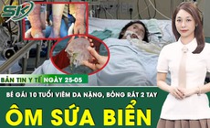 Bản Tin Y Tế 25/5: &#212;m sứa biển trong suốt, b&#233; g&#225;i bị bỏng r&#225;t chằng chịt 2 cẳng tay
