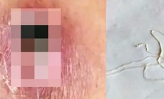 Bệnh giun rồng t&#225;i xuất do ăn gỏi c&#225;, ếch, rắn chưa nấu ch&#237;n nguy hiểm như thế n&#224;o?