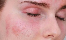 Sử dụng kem chống nắng giả nguy hiểm như thế n&#224;o?