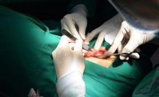 Phẫu thuật thẩm mỹ sẹo, tạo h&#236;nh v&#224;nh tai sau tổn thương do khối u lớn