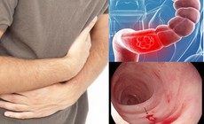 Ph&#225;t hiện mắc ung thư sau 3 th&#225;ng rối loạn ti&#234;u h&#243;a