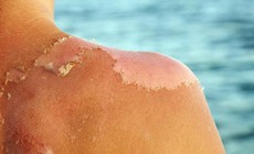 Chữa vi&#234;m da do ch&#225;y nắng, bỏng nắng bằng Đ&#244;ng y