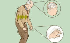 Biểu hiện cho thấy bạn mắc bệnh Parkinson
