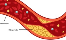 9 c&#225;ch tự nhi&#234;n gi&#250;p giảm cholesterol xấu, bảo vệ tim mạch