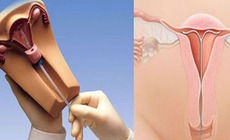Tr&#225;nh thai nội tiết c&#243; thực sự tốt cho phụ nữ?