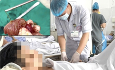 Một thanh ni&#234;n bị xương c&#225; đ&#226;m thủng ruột non, g&#226;y &#225;p xe ổ bụng