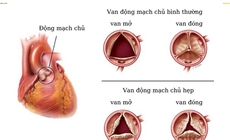 Biến chứng nguy hiểm hẹp van động mạch chủ v&#224; c&#225;ch điều trị