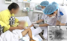 B&#224; đắp thuốc nam cho ch&#225;u bị m&#232;o cắn, cả b&#224;n ch&#226;n hoại tử