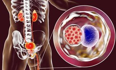 3 bệnh lây truyền qua đường tình dục làm tăng nguy cơ ung thư cổ tử cung