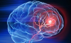 Áp lực, cường độ làm việc cao kéo dài có làm tăng nguy cơ đột quỵ ở người trẻ?