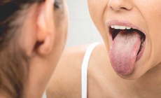 Bị ung thư lưỡi di căn hạch do chủ quan từ vết loét nhỏ