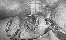 Phẫu thuật nội soi cấp cứu thành công cho nam thanh niên bị đinh xuyên thủng ruột non 