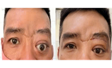 Bệnh hiếm gây lồi mắt, 20 năm Bệnh viện Tai Mũi Họng TPHCM chỉ gặp 2 ca