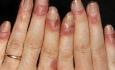 Cách chữa cước tay chân mùa đông tại nhà