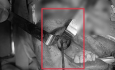 Nấm đen 'ăn' mòn xoang hàm người đàn ông khỏe mạnh