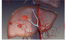 Đau tức hạ sườn, ăn kém, sút cân… cảnh giác với u máu gan