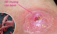 Hai bệnh nhân nguy kịch vì Whitmore, cảnh báo nguy cơ sau mưa lũ