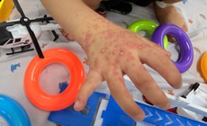 TPHCM: Ca tay chân miệng tăng mạnh, nhiều trẻ đồng nhiễm virus hô hấp