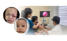 Trẻ 18 tháng tuổi nguy cơ mất thị lực do viêm xoang biến chứng
