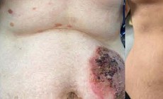 Giải cứu người phụ nữ 7 năm chung sống với các nốt bọng nước đau rát