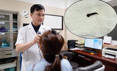 Bắt đỉa sống trong thanh quản người phụ nữ có thói quen uống nước ở suối