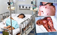 Bệnh não mô cầu có thể gây tử vong trong vài giờ