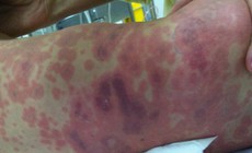 Ghi nhận học sinh thứ 4 mắc não mô cầu, dấu hiệu nào cần nhập viện?
