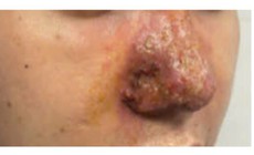 Mũi đầy mủ sau tiêm filler ở spa, bác sĩ cảnh báo biến chứng nguy hiểm
