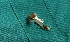 Bé 13 tuổi ho kéo dài hơn 3 năm, bác sĩ phát hiện dị vật nhựa trong phế quản