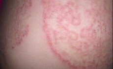 5 nguyên tắc quan trọng giúp phòng ngừa nấm da