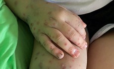 Ghi nhận hơn 1.800 ca tay chân miệng trong 1 tuần: Cảnh giác dấu hiệu bệnh chuyển nặng