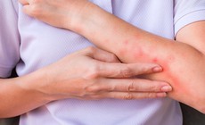 Dấu hiệu viêm da dị ứng bội nhiễm