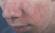 Viêm da tiết bã có lây không?