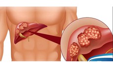 Gan nhiễm mỡ cấp độ mấy phải dùng thuốc kết hợp với ăn kiêng?