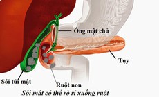 Sỏi túi mật khi nào cần mổ cấp cứu?