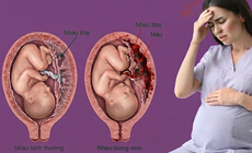 Nhau bong non nguy hiểm như thế nào?